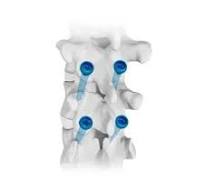 MoP Apollo Cementless Acetabular Cup System,Medical Device ...