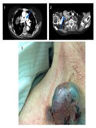 Positive nodes), and/or thyroid cancer that has spread to other parts of the body (i.e. Lymph Node Metastasis In Advanced Papillary Thyroid Cancer