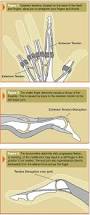 Image result for Extensor Tendon Laceration