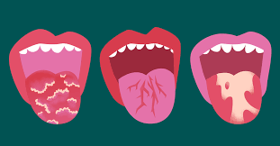 Mouth Sores And Oral Symptoms From Crohn S Or Uc Ibd