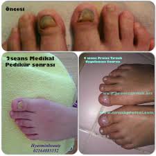 Trinak Yatagi Bozuklugunun Medikal Protez Tirnak Ve Pedikur Le Duzeltilmesi 4 Seans Goruntusu Hyasminbeauty 02164885152 Kartal Istanbul Tirnak Pedikur Tirnak