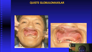 Quistes maxilares Diagnóstico