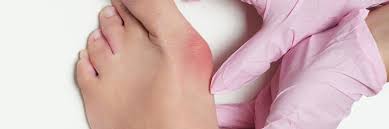 Metatarsal Fractures In Bridgewater, NJ