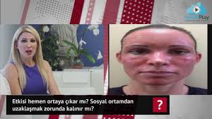 Ülker stadı`nda gerçekleştirilen kongrede 38 sandıkta oy sayım işlemi tamamlandı. Fraksiyonel Co2 Lazerin Etkisi Hemen Ortaya Cikar Mi Dr Nuket Eroglu Izlesene Com