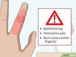 How To Treat A Blistering Burn On Your Finger: 14 Steps