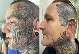 Laser tattoo removal techniques can get rid of your unwanted tattoo with minimal side effects. Can You Get Rid Of Face Tattoos With Laser Tattoo Removal
