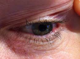 Image result for milium cyst on eyelid