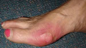 Image result for gout symptoms toe