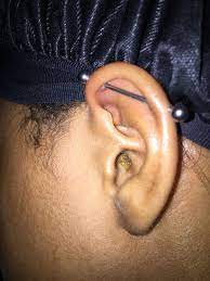 I Ve Had My Industrial Piercing For Around 2 Months Now It Seems A Small Bump Has Formed And I Can T Tell If Keloid Piercing Cartilage Bump Cartilage Piercing