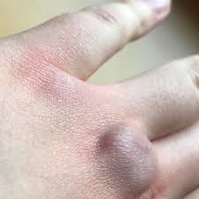 Die schwellung ist nicht so spezifisch wie die schmerzen, auch die angrenzenden finger können betroffen sein. Hand Finger Knochensplitterung Oder Kapselriss Gesundheit Und Medizin Sport Und Fitness Arzt