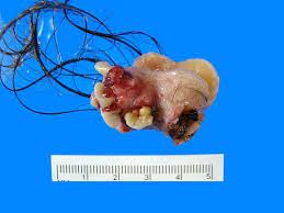 Dermoid ovarian cyst with hair and teeth pictures. Teratoma A Cyst Containing Hair And Teeth Tejidos Humanos Cabello Cuerpo Humano