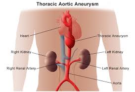 When the aorta is weak, blood pushing against the vessel wall can cause it to bulge like a. Thoracic Aortic Aneurysm Johns Hopkins Medicine