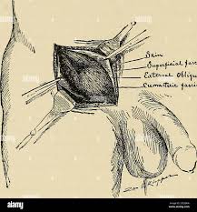 Image result for Blunt Dissection