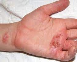 Pin On Contact Dermatitis