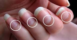 If You Do Not Have Half Moon Shape On Your Nails Immediately Visit A Doctor Nail Health Signs Fingernail Health Moons On Fingernails