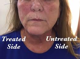 Laser hair removal's gentle technology. Hendersonville Laser Skincare Home Facebook