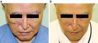 Adipose Tissue-Derived Regenerative Cell-Based Therapies: Current  Optimization Strategies for Effective Treatment in Aesthetic Surgery