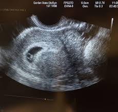 First Ultrasound Itsofficial Wearepregnant 6weeks Firstbaby First Ultrasound First Baby Ultrasound