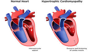 Image result for Cardiomyopathy