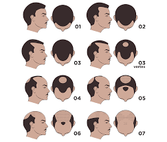 Norwood Scale Hair Loss Lajoshrich Com