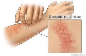 Image result for dermatitis contacta