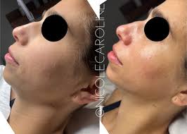 What an absolute honor it was to attend last nights Inaugural #willowgala  with the amazing @rodonfoundation and @ashleyrodon supporting families in  their fertility journey … 1 in 6 women suffer from Infertility