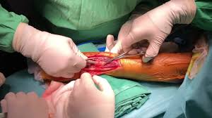 Total replacement of the distal radioulnar joint in pigmented villonodular  synovitis. - Reemplazo total de la articulación radiocubital distal en  sinovitis villonodular pigmentada. | VuMedi