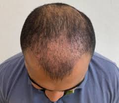 It is important to understand the hair growth time line before planning a transplant. When Do The Hair Grow Back After A Hair Transplant