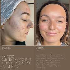 Leah Fraser: Advanced Skin and Laser (@proteaskinandbeauty) • Instagram  photos and videos