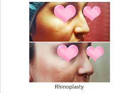 Plastic Surgery Orange County Los Angeles California Newport Beach Plastic Surgeons Pasadena Plastic Surgery Rhinoplasty Nose Job Facial Plastic Surgery