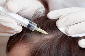 They also say that the anesthesia plays a role in the hair loss, but i've had tons or surgeries and never had hairloss from the anesthesia. Steroid Injections For Hair Loss Modena Hair Institute