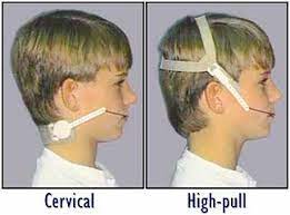 Pin On Orthodontic Treatment Orthodontic Appliances Glauser Williams Orthodontics