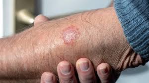 Image result for Atopic eczema atopic dermatitis