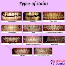 Image result for Tooth Discoloration
