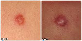 Since most skin cancers are caused by ultraviolet light exposure, skin cancers are generally not considered to be inherited. Mimics Of Skin Cancer Ii Skin Cancer 909