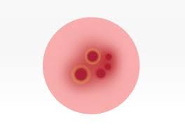 It can also irritate the sore, worsening the appearance of the cold sore and increasing. Cold Sores The 5 Stages Of A Cold Sore Outbreak Orajel