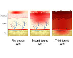Understanding A Burn Injury Model Systems Knowledge