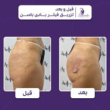 فیلر بادی چیست؟ - معرفی راهکاری ساده برای فرم‌دهی بدن