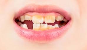 Image result for Tooth Fracture