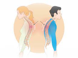 What happens is that the muscle tissue migrates and accumulates at the base of the neck to compensate for the wrong. Dowager S Hump What Is It And How Can You Treat And Prevent It