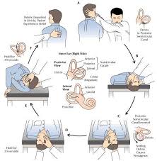 inner ear crystals epley maneuver positional vertigo get