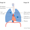 Learn about the common signs and symptoms of lung cancer such as a worsening cough, loss of appetite, or shortness of breath. 1