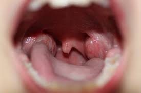 Staphylococcus aureus) este o bacterie patogenă din genul staphylococcus, care poate produce infecții supurative sau septicemii la om și animale. Abcesul Periamigdalian