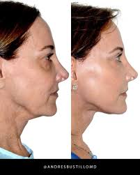 Female underwent a Deep Plane Facelift. Her result is elegant, natural, and  conservative. #DrBustillo #NaturalResults #ConservativeResults