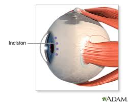 Image result for Cataract Extraction
