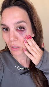Yikes! 😳 Former Disney star Christy Carlson Romano nearly lost an eye  while shooting clay pigeons with her husband, Brendan Rooney, for his  birthday. "It was not fun," she said in the