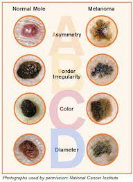 The abcdes of melanoma are a way to classify cancerous moles. The Abcde Rules Of Skin Cancer Inside Outer Beauty Blog