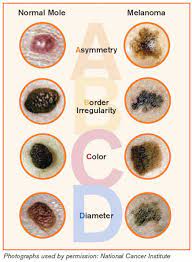 The edges are uneven or ragged. The Abcde Rules Of Skin Cancer Inside Outer Beauty Blog