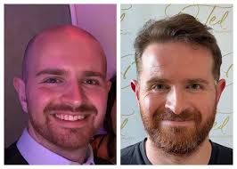 FUE Hair Transplant Cost UK [2024]