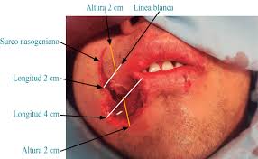 Abbey eslander flap is used in reconstruction of? Versatility Of Estlander Flap In Lip Reconstruction